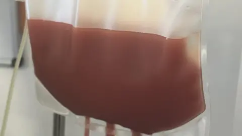 A close up image of the bag stem cells collected from Jordan's blood over more than four hours 