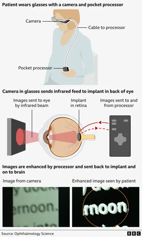 The graphic shows how the technology works. There is an illustration of a patient with the implant wearing glasses with a built-in video camera and holding a processor connected by wire to the glasses.
Below, another graphic shows how the camera sends images to the implant at the back of the eye, via infrared beam. A close-up of the eye shows the implant receiving those infrared images and then sending them on to a black hand-held processor. Red arrows highlight that the images are sent to the processor, enhanced and then sent back to the implant and on to the brain.
A third graphic illustrates the way the images are enhanced. On the left is an image from the camera showing part of a word. The letters 'ernoon' are coloured black on a white background and appear slightly blurred. On the right is an enhanced image seen by the patient where the letters (now white) are bold and stand out against a black background.